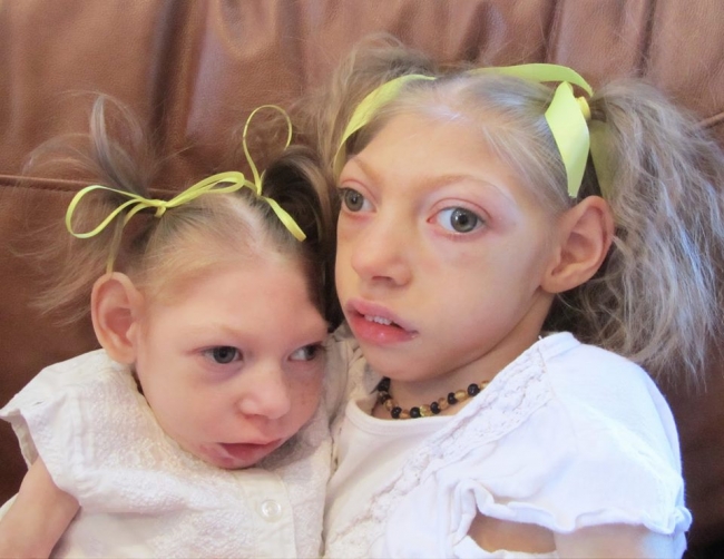 children-born-with-microcephaly