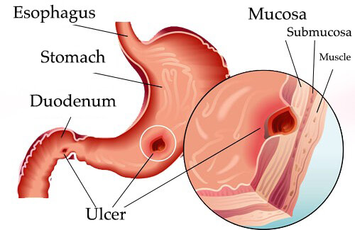Ulcer-white-background1