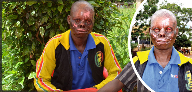 Kifafa chamharibu Kijana Pua, Macho - Global Publishers