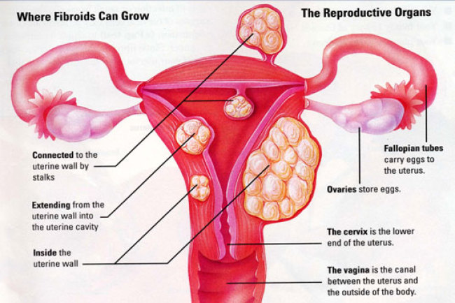 Uvimbe wa Kizazi ‘Uterine Fibroids’ - Global Publishers