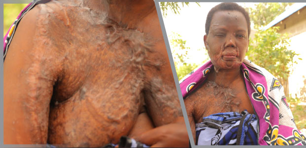 Mke: Mume Wangu  Amenimwagia Tindikali - Global Publishers