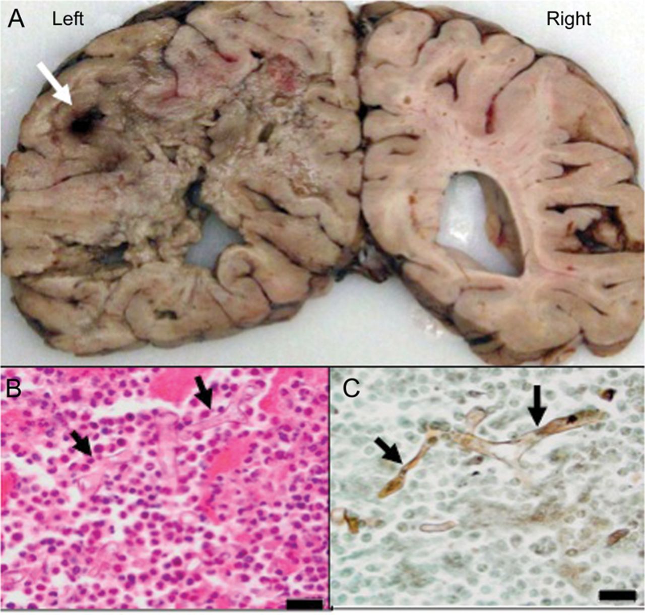 Tatizo la Fangasi Kwenye Ubongo - Global Publishers