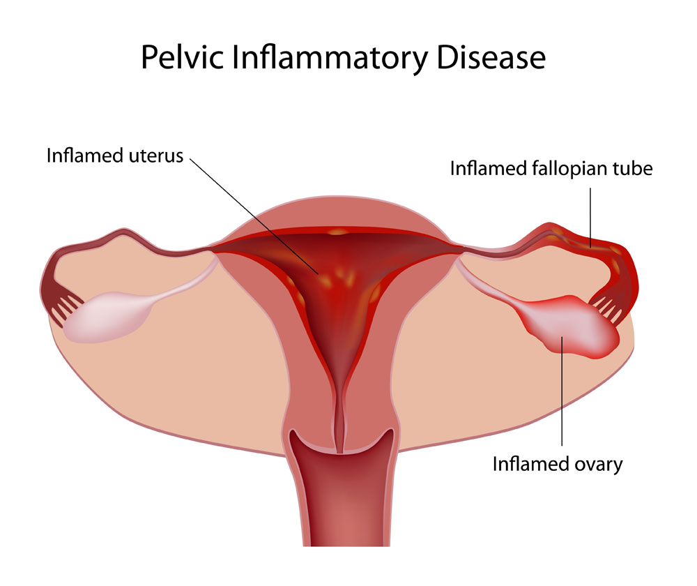 pelvic-inflamatory-disease