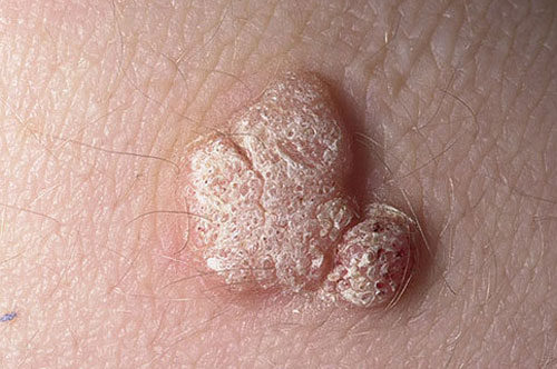 genital-warts-pictures-500x332