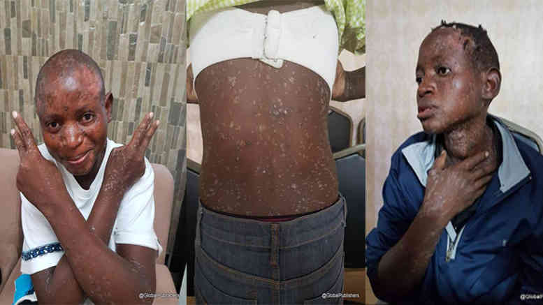 BINTI HUYU ANASIKITISHA, APATA GONJWA ATIMULIWA KWAO - Global Publishers