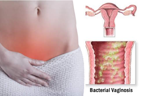 Tatizo la Kutokwa na Uchafu Ukeni (Vaginosis)