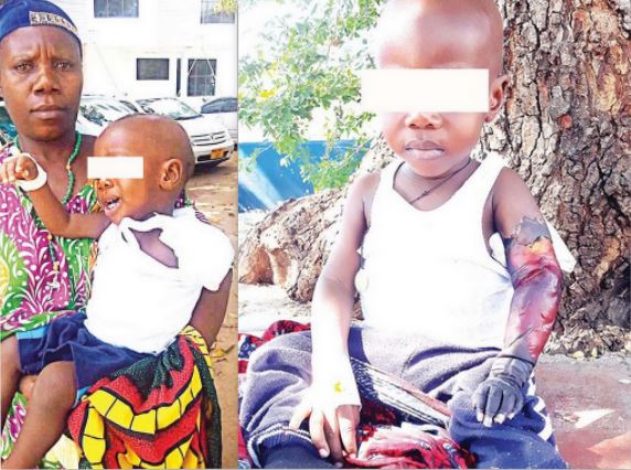 MUHIMBILI YATOA TAMKO MTOTO ALIYEKATWA MKONO - Global Publishers