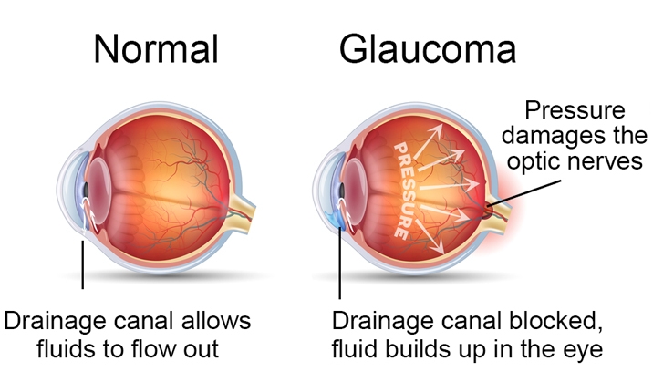 GLAUCOMA; UGONJWA USIO NA DALILI UNAOSABABISHA UPOFU - Global Publishers