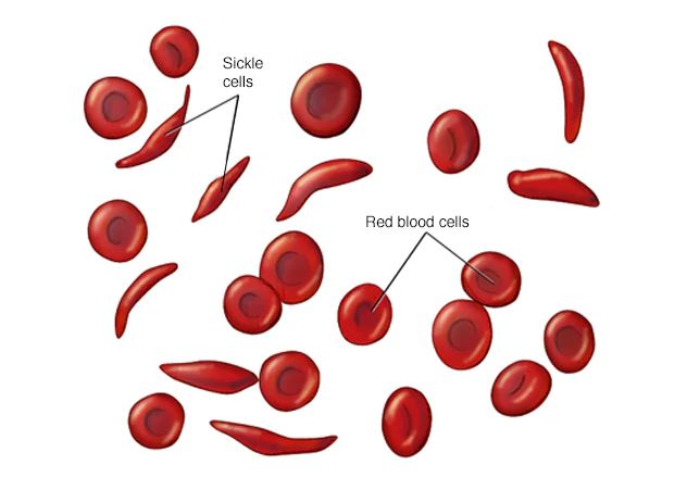Dawa anazopaswa, asizopaswa kutumia mgonjwa wa selimundu - Global Publishers