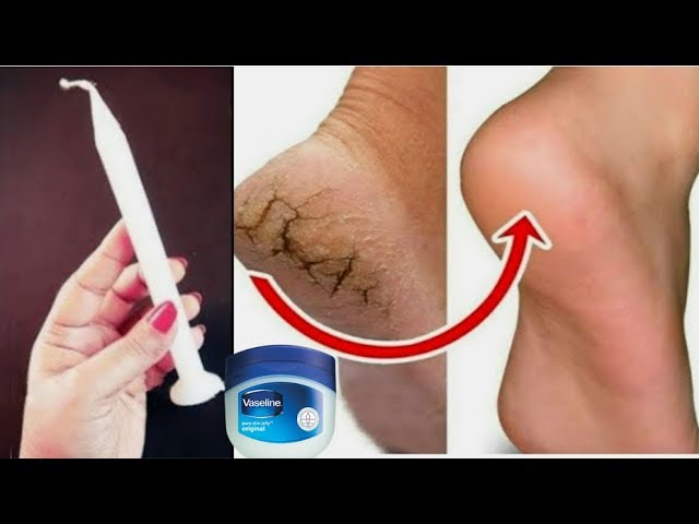 Tumia Mshumaa Kuondoa MagagaMiguuni! - Global Publishers