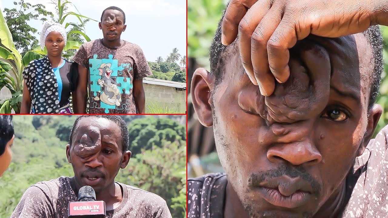Video: Kijana Aishi Miaka 12 na Uvimbe Usoni, Ndugu Wamemtenga - Global Publishers