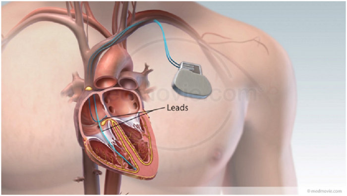 Ufahamu Ugonjwa wa Moyo wa Mfumo wa Umeme (Atrial Fibrillation) - Global Publishers