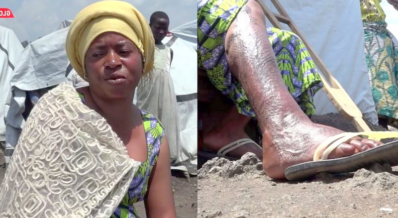 Huzuni! Mama Asimulia Alivyolipukiwa Na Bomu Kisha Kunusurika Kifo – “Sasa Nimekuwa Mlemavu”-Video - Global Publishers