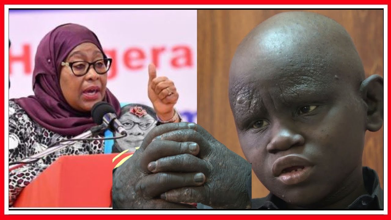 Mtoto Aliyesaidiwa Na Rais Aongea Kwa Uchungu…”Kama Siyo Rais Samia Kuniona Ningekuwa Nimekufa”-Video - Global Publishers