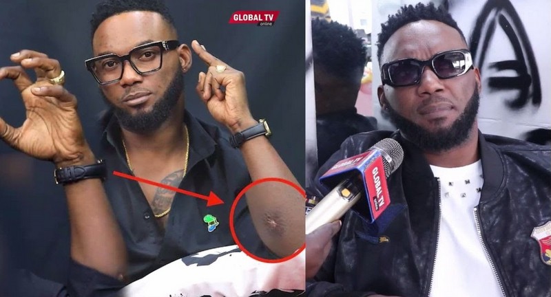 #Exclusive: Duma Afichua Alivyooza Mkono Kimaajabu Hadi Akafanyiwa Oparesheni – ”Walitoa Nyama”… - Global Publishers