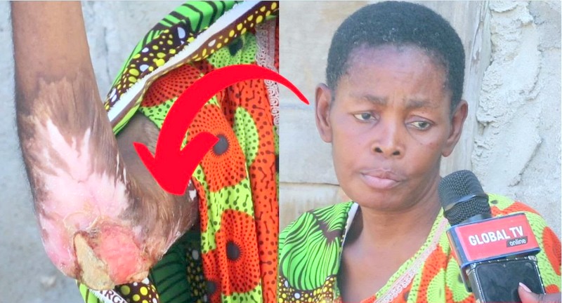 Mama Aungua Na Maharage Hadi Mfupa Unaonekana, Alia Akiomba Msaada – Video - Global Publishers