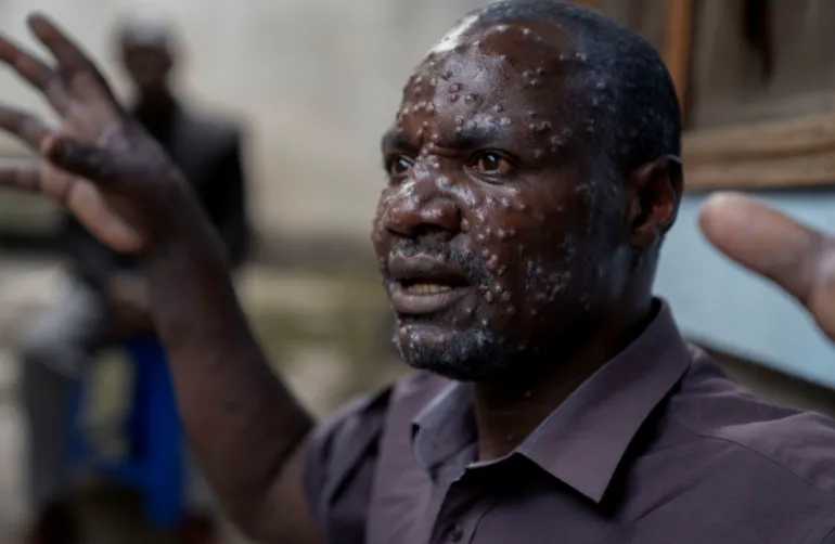 WHO yasema Mpox inaweza kutokomezwa - Global Publishers