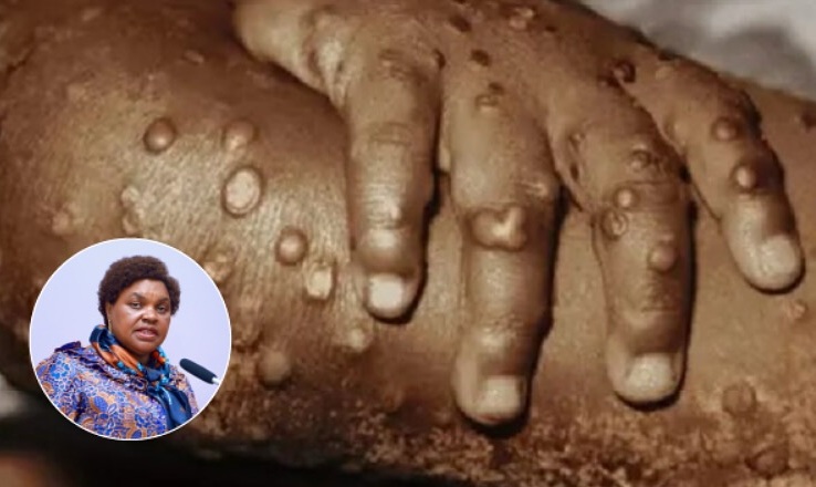 Watu Wawili Wathibitika kuwa na Maambukizi ya Mpox, Waziri Mhagama Afunguka - Global Publishers