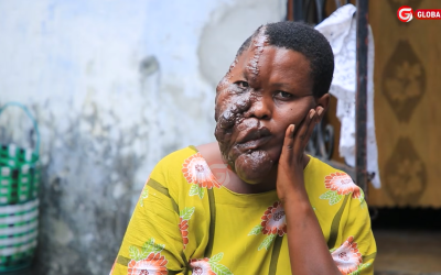 Aishi na Uvimbe Miaka 20 Aomba Msaada wa Matibabu, Afunguka Mazito -Video - Global Publishers
