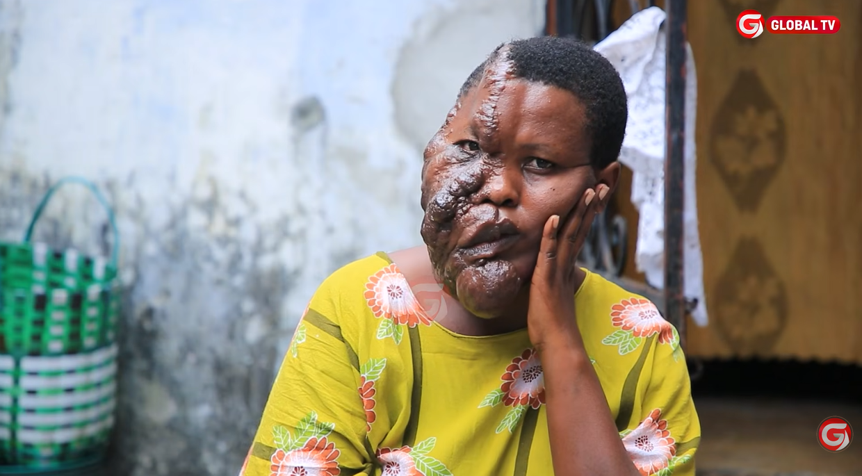 Aishi na Uvimbe Miaka 20 Aomba Msaada wa Matibabu, Afunguka Mazito -Video